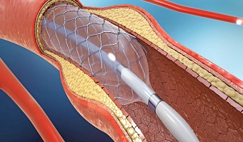 Angioplasty centre affordable in Pune Heart Operation