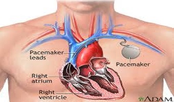 Pacemaker Check in Pune near you 